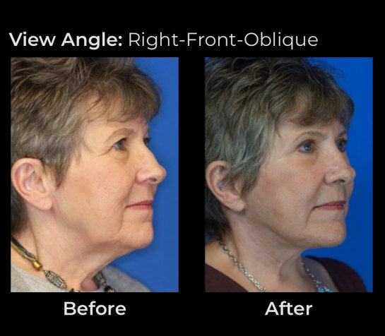 Eyelids Plastic Surgery at Face Works Plastic Surgery, Plastic Surgeon Near Me in Schaumburg, IL Eyelids Plastic Surgery at Face Works Plastic Surgery, Plastic Surgeon Near Me in Schaumburg, IL