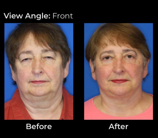 Eyelids Plastic Surgery at Face Works Plastic Surgery, Plastic Surgeon Near Me in Schaumburg, IL Eyelids Plastic Surgery at Face Works Plastic Surgery, Plastic Surgeon Near Me in Schaumburg, IL