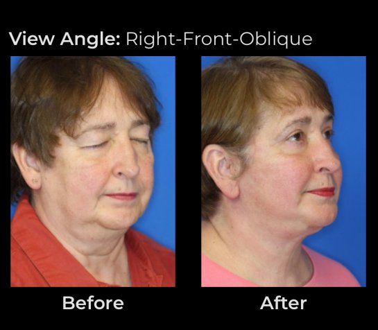 Eyelids Plastic Surgery at Face Works Plastic Surgery, Plastic Surgeon Near Me in Schaumburg, IL Eyelids Plastic Surgery at Face Works Plastic Surgery, Plastic Surgeon Near Me in Schaumburg, IL