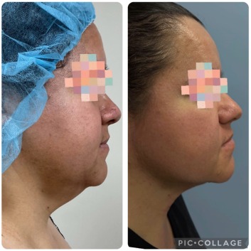 Before and After HD LipoX® of Jawline at Face Works Plastic Surgery, Plastic Surgeon Near Me in Schaumburg, IL Before and After HD LipoX® of Jawline at Face Works Plastic Surgery, Plastic Surgeon Near Me in Schaumburg, IL