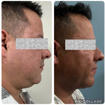 Before and After HD LipoX® of Jawline at Face Works Plastic Surgery, Plastic Surgeon Near Me in Schaumburg, IL Before and After HD LipoX® of Jawline at Face Works Plastic Surgery, Plastic Surgeon Near Me in Schaumburg, IL