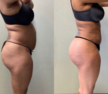 Body Liposuction at Face Works Plastic Surgery, Plastic Surgeon Near Me in Schaumburg, IL Body Liposuction at Face Works Plastic Surgery, Plastic Surgeon Near Me in Schaumburg, IL