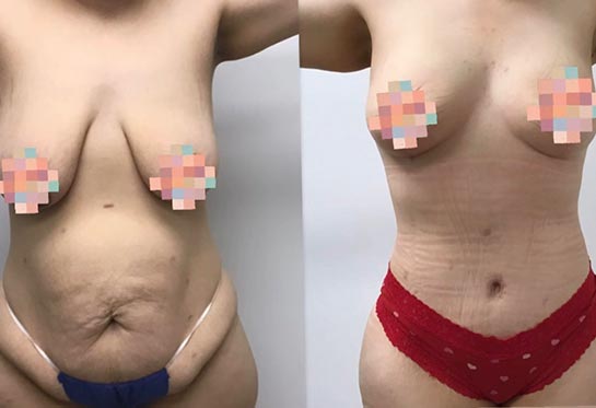 Tummy Tuck at Face Works Plastic Surgery, Plastic Surgeon Near Me in Schaumburg, IL Tummy Tuck at Face Works Plastic Surgery, Plastic Surgeon Near Me in Schaumburg, IL