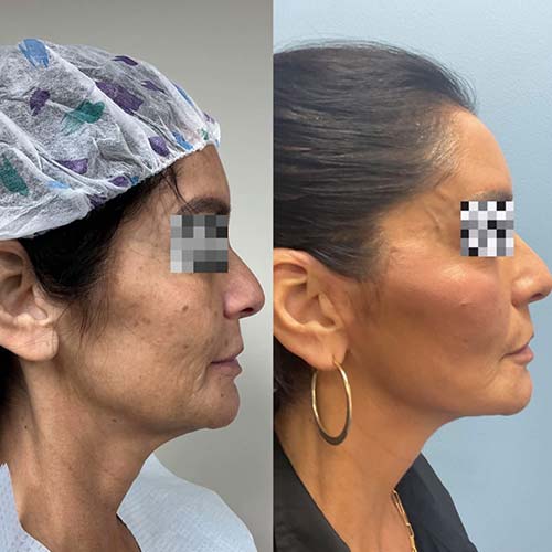 Before and After Face & Neck Lift at Face Works Plastic Surgery Near Me in Schaumburg, IL