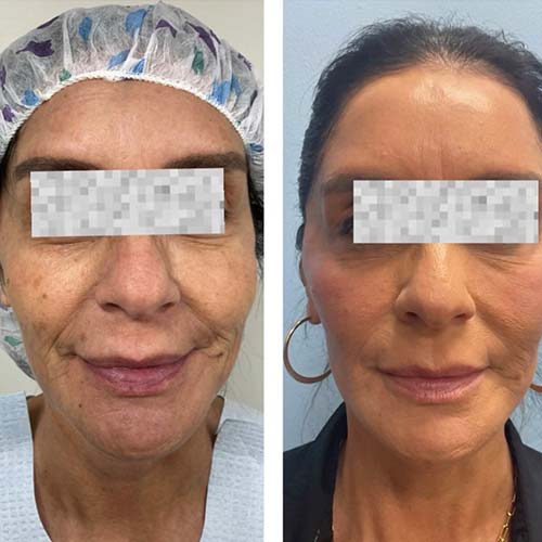 Before and After Face & Neck Lift at Face Works Plastic Surgery Near Me in Schaumburg, IL
