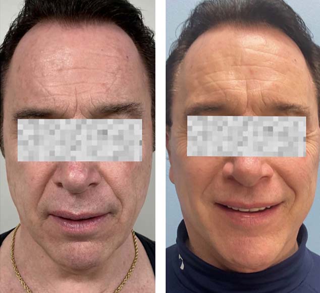Before and After Face & Neck Lift at Face Works Plastic Surgery Near Me in Schaumburg, IL