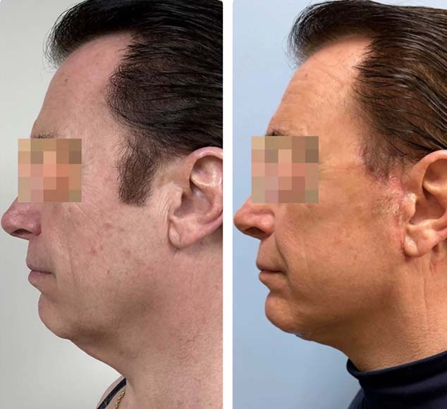Before and After Face & Neck Lift at Face Works Plastic Surgery Near Me in Schaumburg, IL