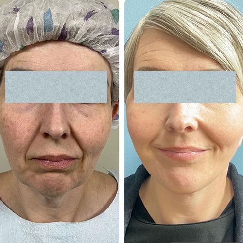 Before and After Face & Neck Lift at Face Works Plastic Surgery Near Me in Schaumburg, IL