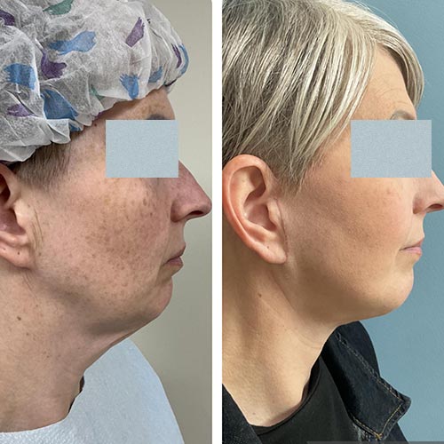 Before and After Face & Neck Lift at Face Works Plastic Surgery Near Me in Schaumburg, IL