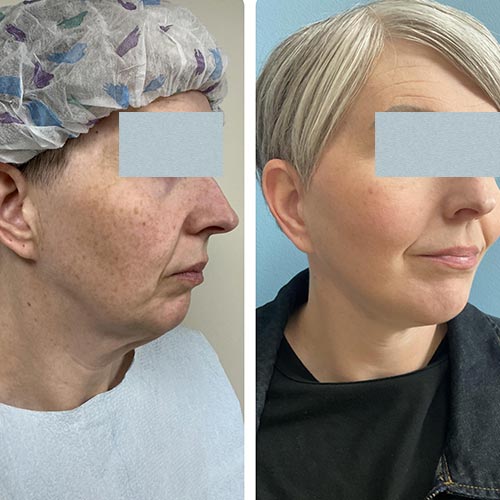 Before and After Face & Neck Lift at Face Works Plastic Surgery Near Me in Schaumburg, IL