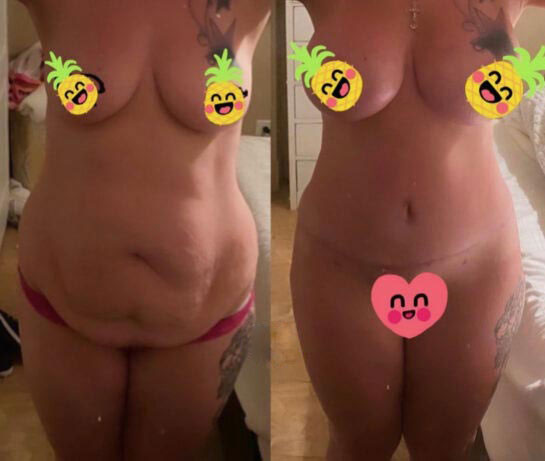 Before and After Tummy Tuck at Face Works Plastic Surgery, Plastic Surgeon Near Me in Schaumburg, IL
