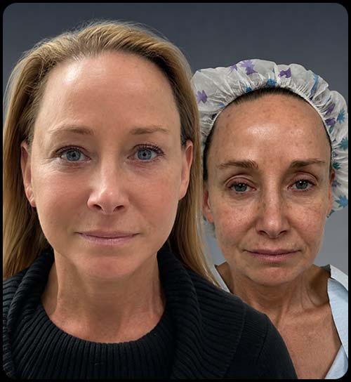Before and After at Face Works Plastic Surgery, Plastic Surgeon in Schaumburg, IL
