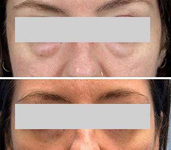 Eyelids Plastic Surgery at Face Works Plastic Surgery, Plastic Surgeon Near Me in Schaumburg, IL Eyelids Plastic Surgery at Face Works Plastic Surgery, Plastic Surgeon Near Me in Schaumburg, IL