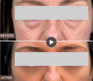 Eyelids Plastic Surgery at Face Works Plastic Surgery, Plastic Surgeon Near Me in Schaumburg, IL Eyelids Plastic Surgery at Face Works Plastic Surgery, Plastic Surgeon Near Me in Schaumburg, IL