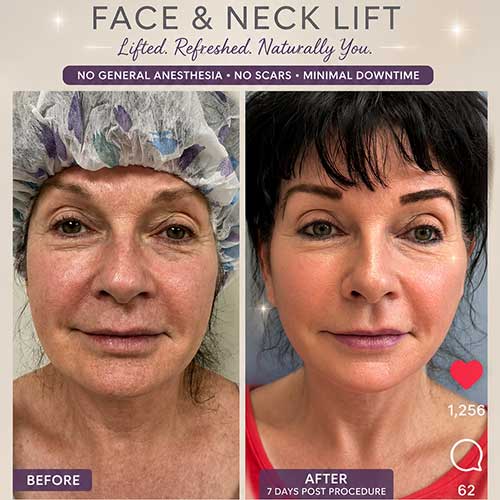 Before and After Face & Neck Lift at Face Works Plastic Surgery Near Me in Schaumburg, IL