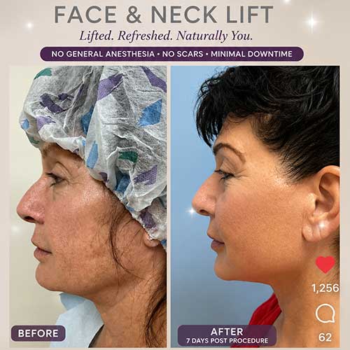 Before and After Face & Neck Lift at Face Works Plastic Surgery Near Me in Schaumburg, IL