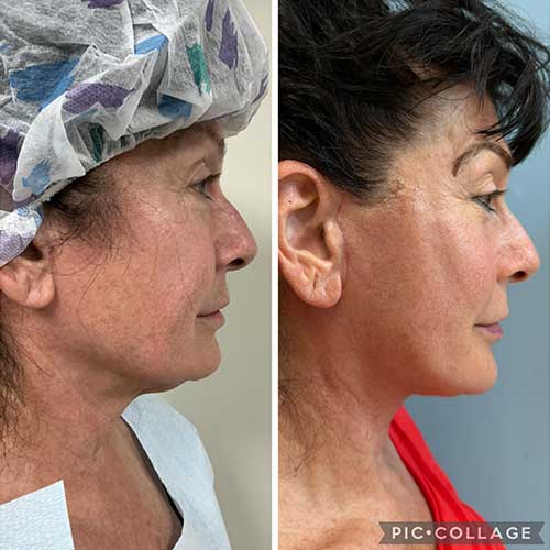 AwakeTight™ at Face Works Plastic Surgery, Plastic Surgeon Near Me in Schaumburg,