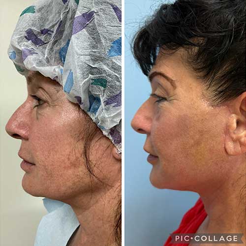 AwakeTight™ at Face Works Plastic Surgery, Plastic Surgeon Near Me in Schaumburg,