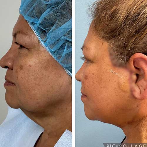 Before and After Face & Neck Lift at Face Works Plastic Surgery Near Me in Schaumburg, IL