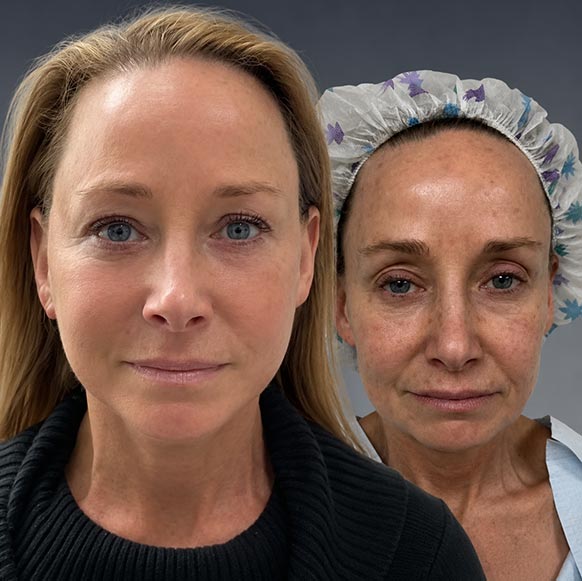 Face Lift at Face Works Plastic Surgery, Plastic Surgeon Near Me in Schaumburg, IL