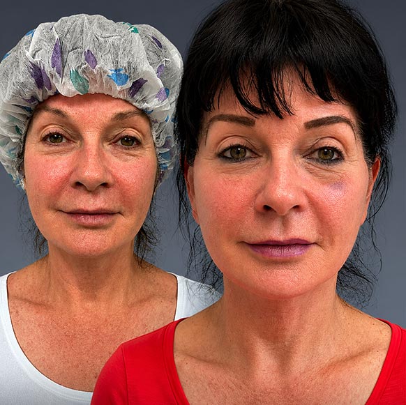 Face Lift at Face Works Plastic Surgery, Plastic Surgeon Near Me in Schaumburg, IL